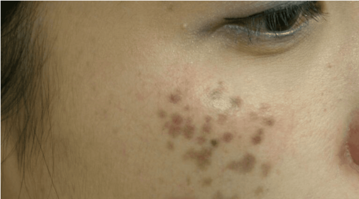 Điều trị Nuvus Hori