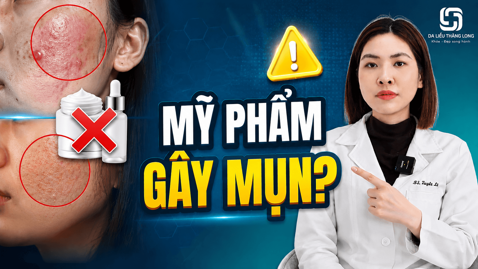 Dấu hiệu nhận biết mụn do mỹ phẩm không an toàn