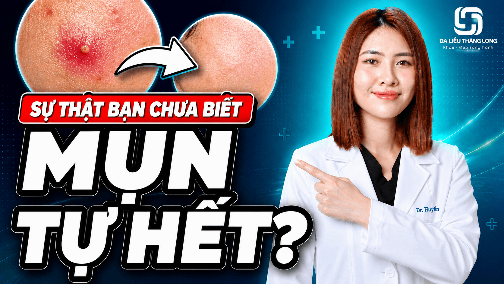 Không nặn mụn có tự hết không? Bác sĩ giải thích quá trình tự lành của mụn