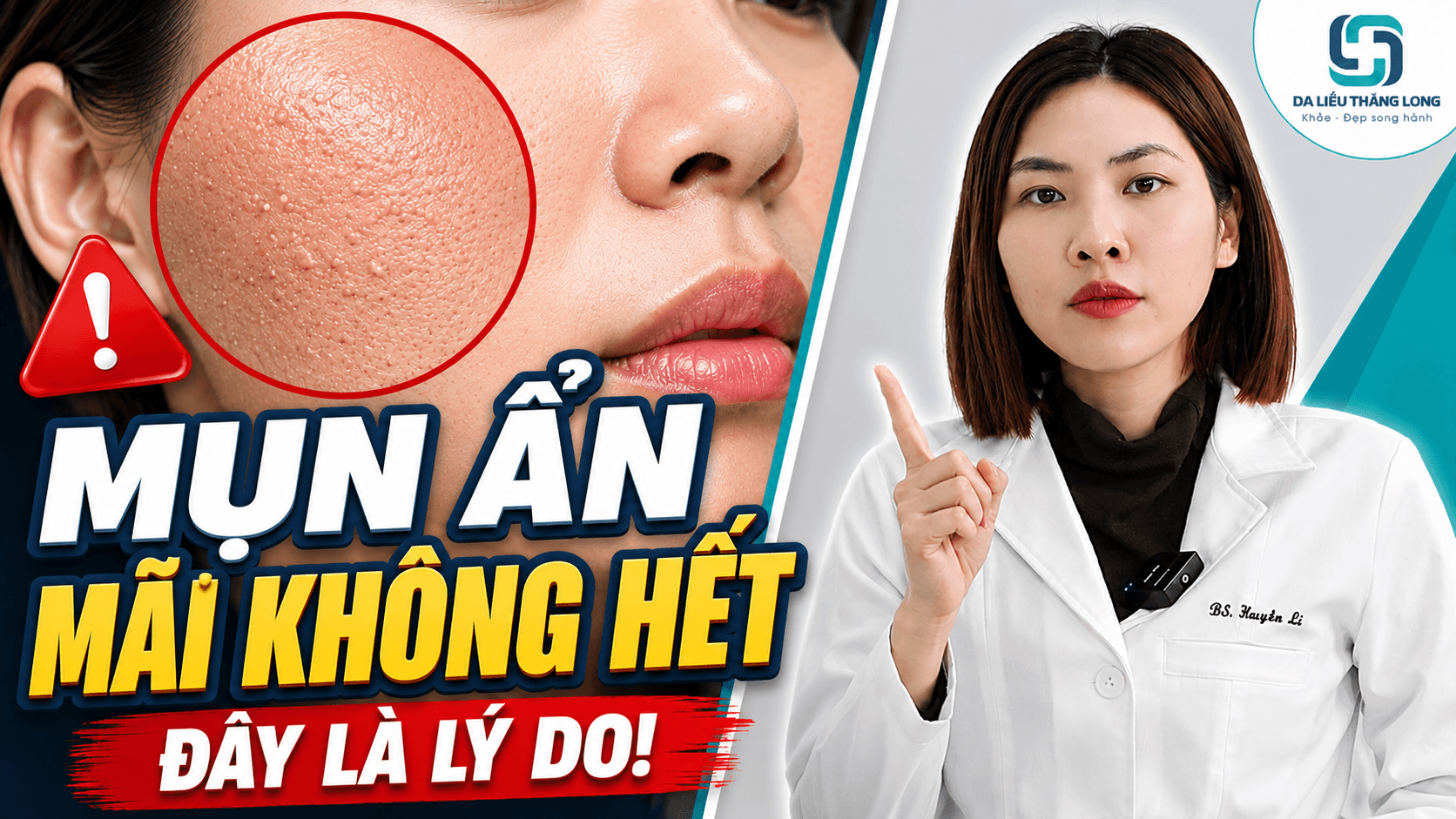 Mụn ẩn không hết dù da không xấu: Lý do bạn nên biết