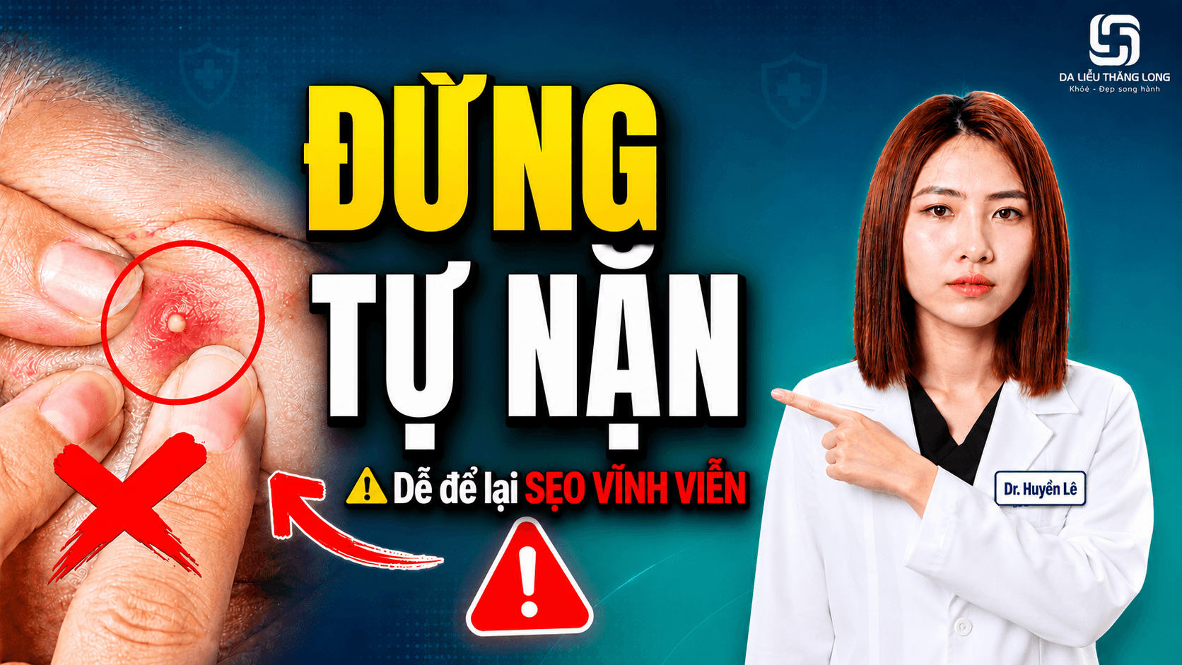 Mụn trứng cá có nên tự nặn tại nhà không?