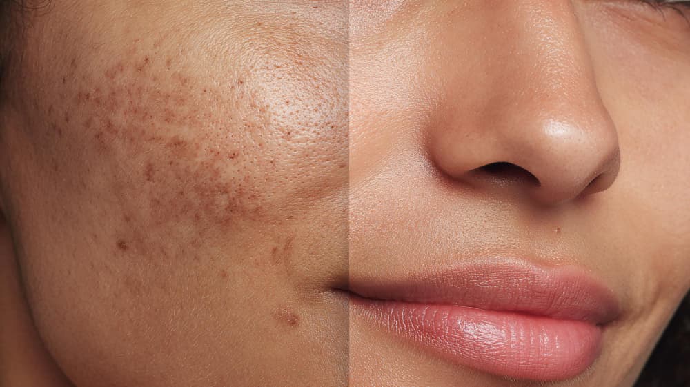 Điều trị nám