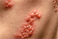 Nhóm bệnh da do virus