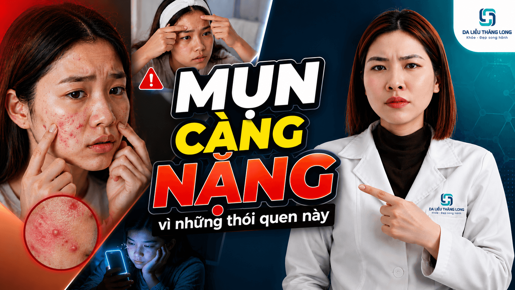 Những thói quen khiến mụn tuổi dậy thì nặng hơn mà nhiều bạn trẻ không để ý