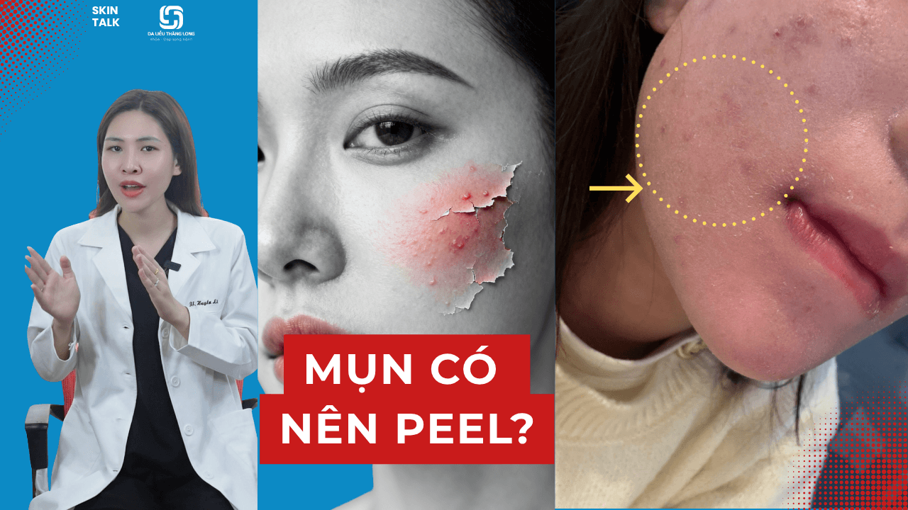 Peel mụn là gì? Da mụn có nên peel da không và những điều cần lưu ý