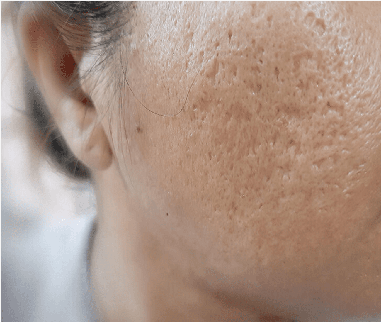 Điều trị sẹo lõm